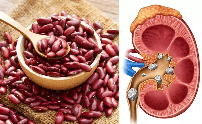 రాజ్మా రాళ్లను కరిగిస్తుందా.. ఆరోగ్య నిపుణులు ఏం చెప్తున్నారు.. రాజ్మా రాళ్లను కరిగిస్తుందా.. ఆరోగ్య నిపుణులు ఏం చెప్తున్నారు..