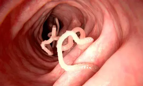 ఉడికీ ఉడకని చేపని ఫ్రిజ్లో నిల్వ ఉంచి తినేసరికి.. ఆమె కడుపులో ఉడికీ ఉడకని చేపని ఫ్రిజ్లో నిల్వ ఉంచి తినేసరికి.. ఆమె కడుపులో