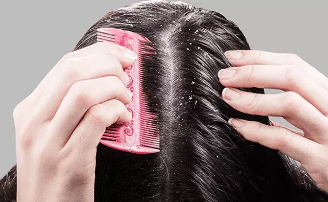 Home Remedies to cure Dandruff : చుండ్రు సమస్యని నివారించే ఇంటి చిట్కాలు..