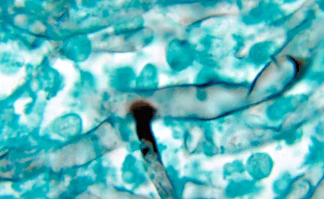 Black Fungus: భయపెడుతున్న బ్లాక్ ఫంగస్.. అసలేంటిది