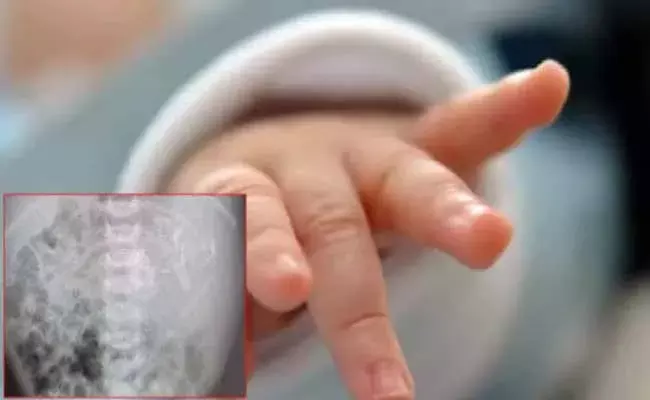 newborn baby girl who was found to have an embryo inside