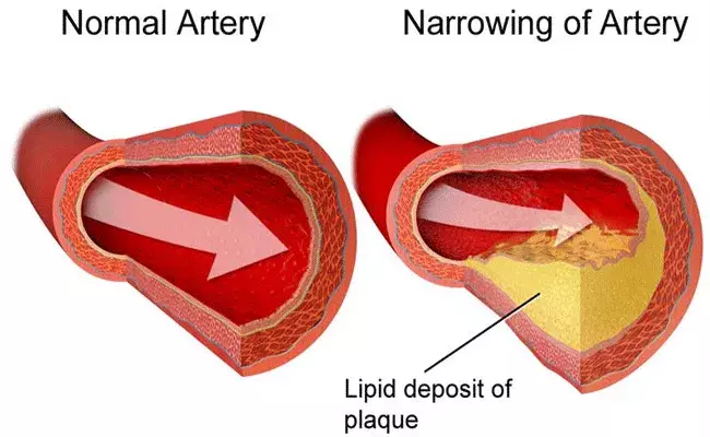 Cholesterol: కొలెస్ట్రాల్ స్థాయిలను తగ్గించే సహజ మార్గాలు.. Cholesterol: కొలెస్ట్రాల్ స్థాయిలను తగ్గించే సహజ మార్గాలు..