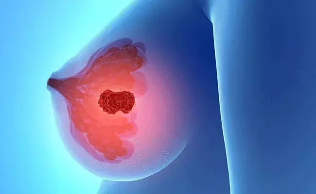 Breast Cancer: బ్రెస్ట్ క్యాన్సర్‌ని గుర్తించడం ఎలా? హంసానందిని విషయంలో..