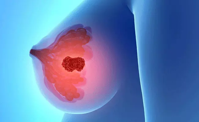 Breast Cancer: బ్రెస్ట్ క్యాన్సర్ని గుర్తించడం ఎలా? హంసానందిని విషయంలో.. Breast Cancer: బ్రెస్ట్ క్యాన్సర్ని గుర్తించడం ఎలా? హంసానందిని విషయంలో..