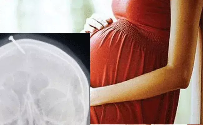 Pakistan: మగపిల్లాడు పుట్టాలంటే.. తలలో మేకు కొట్టాలి.. భూత వైద్యుడి మాటలు నమ్మి.. Pakistan: మగపిల్లాడు పుట్టాలంటే.. తలలో మేకు కొట్టాలి.. భూత వైద్యుడి మాటలు నమ్మి..