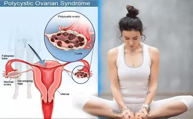 PCOD/PCOS: మహిళలను వేధించే PCOD/PCOS.. ఈ యోగా ఆసనాల ద్వారా.. PCOD/PCOS: మహిళలను వేధించే PCOD/PCOS.. ఈ యోగా ఆసనాల ద్వారా..