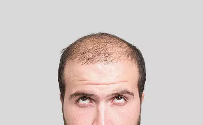 Bald Head: బట్టతల అని పిలవడం లైంగిక వేధింపుతో సమానం.. ట్రైబ్యునల్‌ తీర్పు..