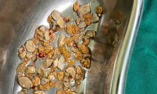 kidney stones :  అతడి కిడ్నీలో 206 రాళ్లు.. గంటలో తొలగించిన వైద్యులు..! kidney stones :  అతడి కిడ్నీలో 206 రాళ్లు.. గంటలో తొలగించిన వైద్యులు..!