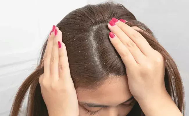Dandruff: చుండ్రు నివారణకు ఆయుర్వేదం.. Dandruff: చుండ్రు నివారణకు ఆయుర్వేదం..
