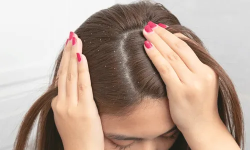 Dandruff: చుండ్రు నివారణకు ఆయుర్వేదం.. Dandruff: చుండ్రు నివారణకు ఆయుర్వేదం..