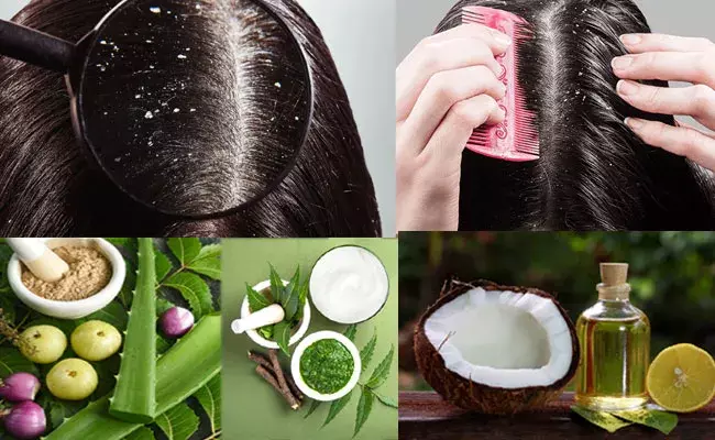 Dandruff treatment: చుండ్రుకు చిటికెలో చెక్.. గన్ షాట్ హోమ్ రెమెడీస్.. Dandruff treatment: చుండ్రుకు చిటికెలో చెక్.. గన్ షాట్ హోమ్ రెమెడీస్..