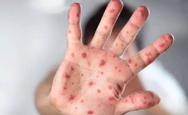Monkey Pox : భారత్లోకి మంకీపాక్స్ ఎంట్రీ.. కేరళలో మొదటి కేసు Monkey Pox : భారత్లోకి మంకీపాక్స్ ఎంట్రీ.. కేరళలో మొదటి కేసు