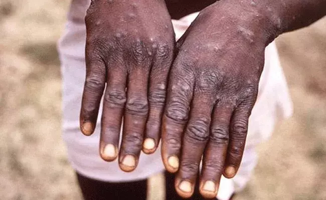 Monkey Pox : మంకీపాక్స్ రెండో కేసు.. విదేశాల నుంచే దిగుమతి.. Monkey Pox : మంకీపాక్స్ రెండో కేసు.. విదేశాల నుంచే దిగుమతి..