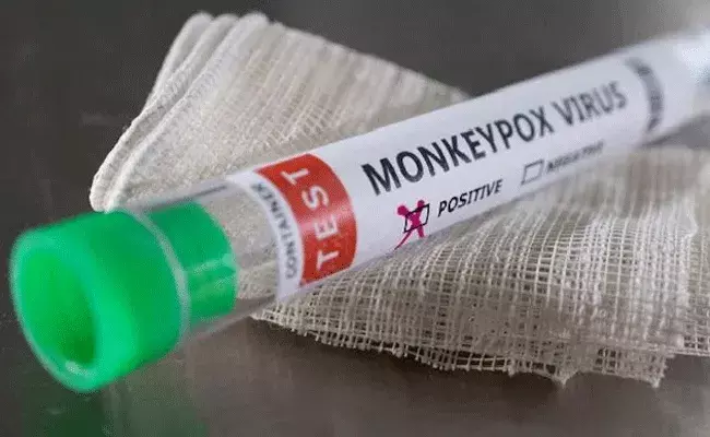 Kamareddy: కామారెడ్డిలో మంకీపాక్స్‌ కలకలం.. అది ప్రాణాంతక వ్యాధి కాదంటున్న డీహెచ్..