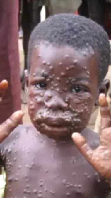 Monkey Pox : భారత్‌లోకి మంకీపాక్స్ ఎంట్రీ.. విదేశాల నుంచే దిగుమతి..