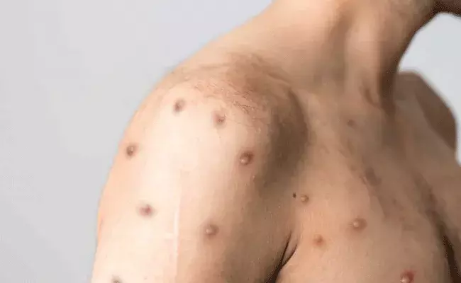 Kerala Monkey Pox : తొలి మంకీ పాక్స్ కేసు.. తొలి మంకీ పాక్స్ మృతి కేసు అక్కడే.. Kerala Monkey Pox : తొలి మంకీ పాక్స్ కేసు.. తొలి మంకీ పాక్స్ మృతి కేసు అక్కడే..