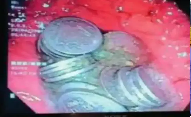 Rajasthan: అతడి కడుపులో 63 రూపాయి నాణేలు..