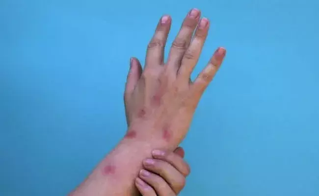 Monkeypox Allert: మంకీపాక్స్ అలెర్ట్.. కేంద్ర ఆరోగ్య మంత్రిత్వ శాఖ విడుదలచేసిన జాబితా.. Monkeypox Allert: మంకీపాక్స్ అలెర్ట్.. కేంద్ర ఆరోగ్య మంత్రిత్వ శాఖ విడుదలచేసిన జాబితా..