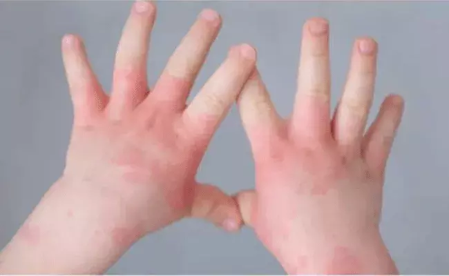 Tomato Flu: అసలు టమాట ఫ్లూ అంటే ఏంటి..? ఎలా గుర్తించాలి..? Tomato Flu: అసలు టమాట ఫ్లూ అంటే ఏంటి..? ఎలా గుర్తించాలి..?