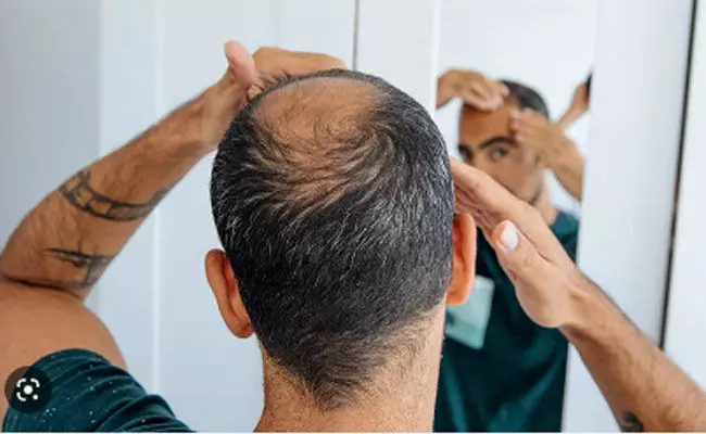 Hair loss in men: పురుషుల్లో బట్టతల.. చక్కెర పానీయాలు ఎక్కువగా తీసుకుంటే.. Hair loss in men: పురుషుల్లో బట్టతల.. చక్కెర పానీయాలు ఎక్కువగా తీసుకుంటే..