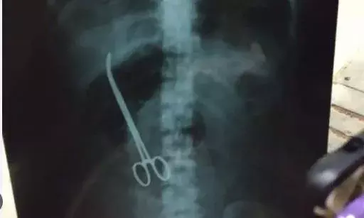 TS : 6ఏళ్ల క్రితం మహిళ కడుపులో ఆపరేషన్ కత్తి మర్చిపోయిన డాక్టర్లు