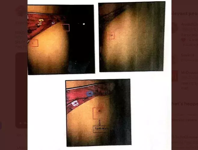 Hyderabad : మెక్ డొనాల్డ్స్ లో చిన్నారిని కరిచిన ఎలుక