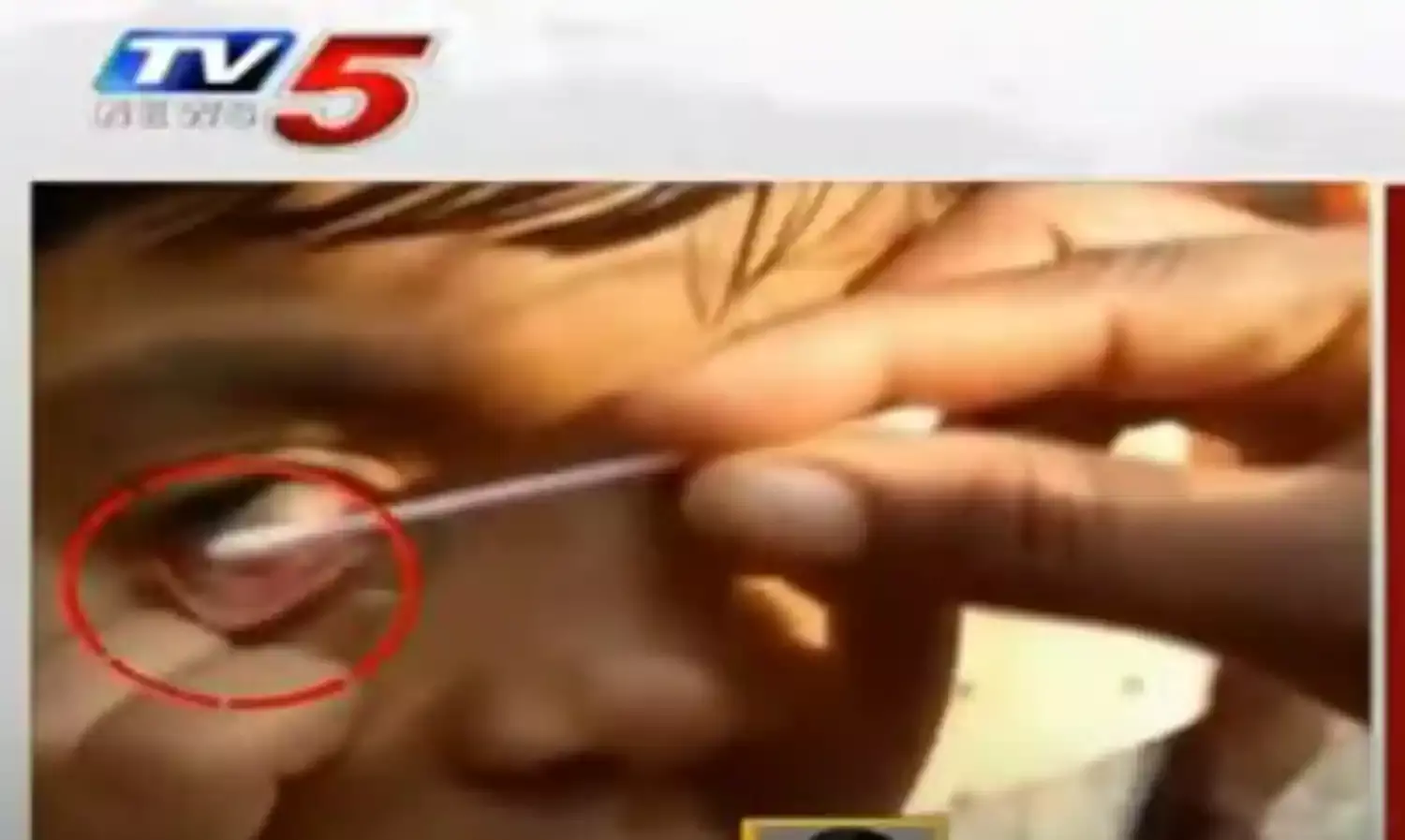 అమ్మో పాప కంటి నుంచి ప్లాస్టిక్, ఇనుము అమ్మో పాప కంటి నుంచి ప్లాస్టిక్, ఇనుము