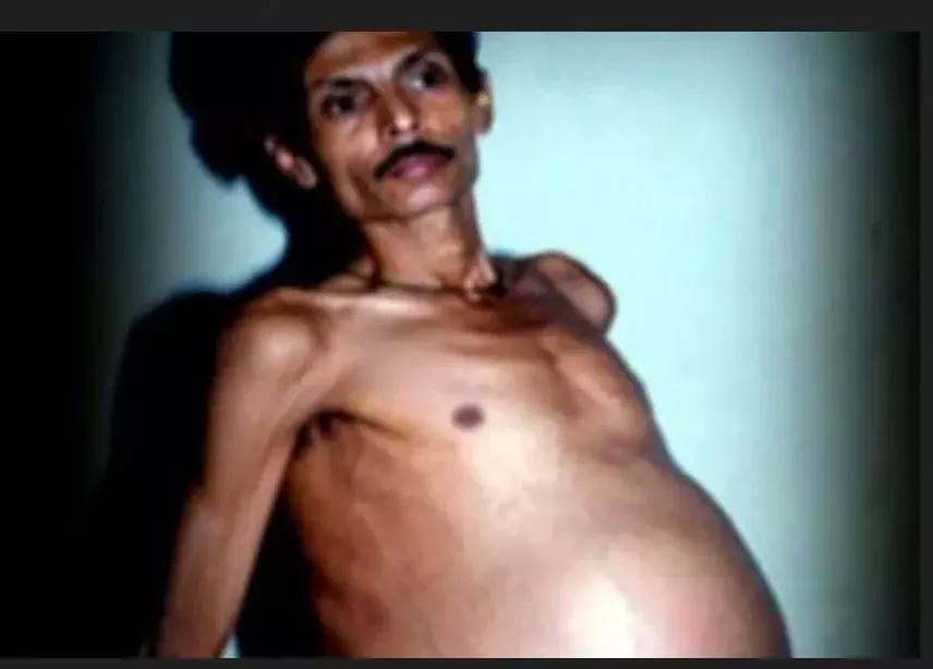 పురుషుడికి 36 ఏళ్లుగా గర్భం.. వైద్యశాస్త్రంలో అద్భుతం