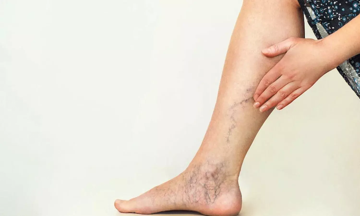 వేధించే వెరికోస్ వెయిన్స్.. 5 బెస్ట్ హోం రెమిడీస్
