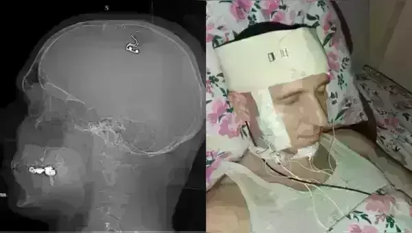 Brain Chip: డ్రిల్లింగ్ మిషిన్‌తో తలకి స్వయంగా సర్జరీ...  ఎందుకంటే..