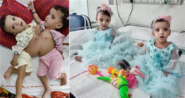 AIIMS Doctors: అవిభక్త కవలను విడదీసి ప్రాణం పోసారు