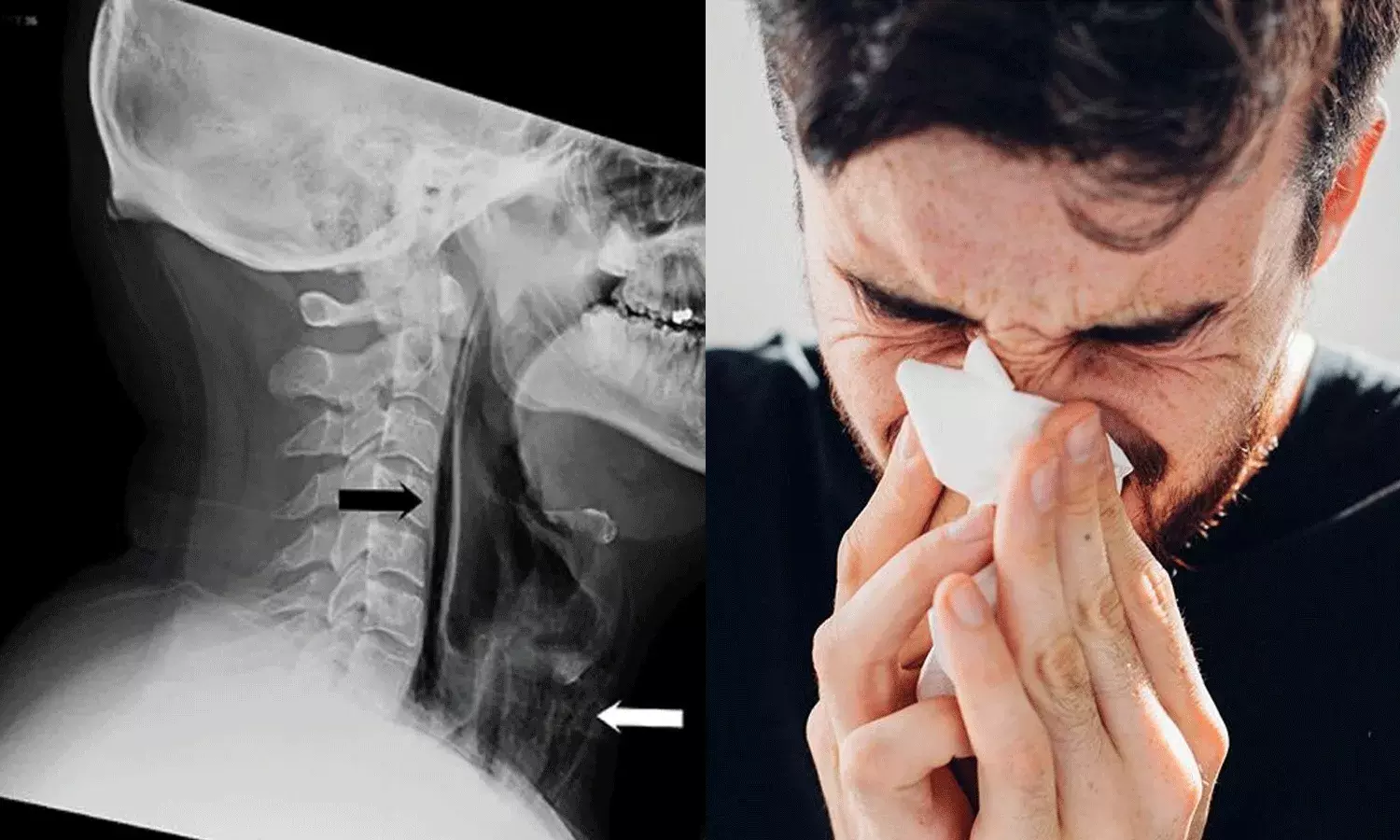 తుమ్మును ఆపుతున్నారా.. చాలా డేంజర్ సుమీ.. తుమ్మును ఆపుతున్నారా.. చాలా డేంజర్ సుమీ..