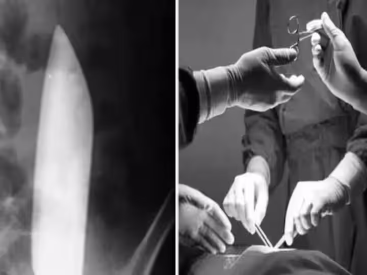 Knife In Stomach: కడుపు నొప్పితో వెళితే కత్తి బయటపడింది Knife In Stomach: కడుపు నొప్పితో వెళితే కత్తి బయటపడింది