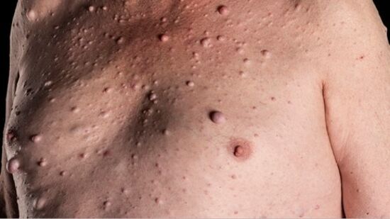 Neurofibromatosis (NF1) : న్యూరోఫైబ్రోమాటోసిస్ టైప్ 1 అంటే ఏంటంటే..