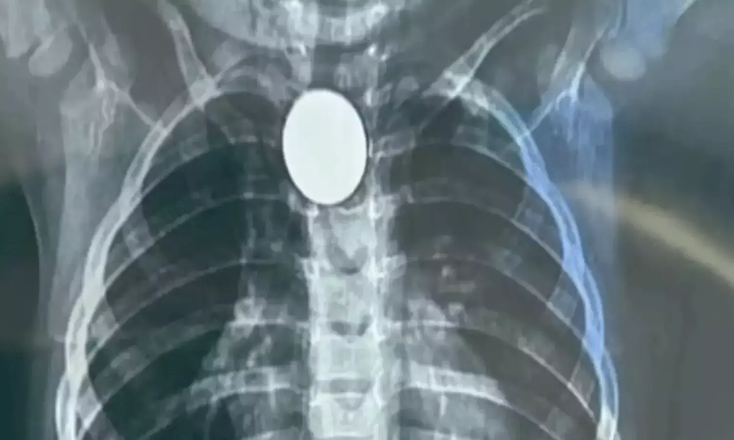 ఆడుకుంటూ రూపాయి నాణెం మింగిన చిన్నారి.. 90 సెకన్లలో తొలగించిన వైద్యులు