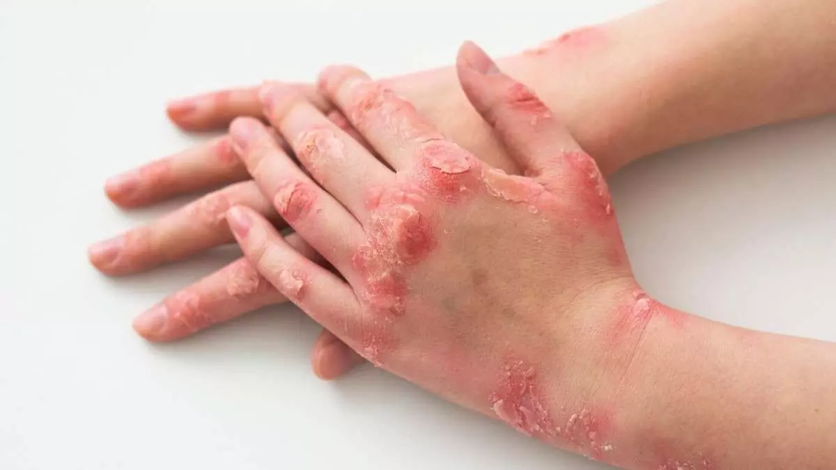 Skin Problems : డయాబెటిస్ వల్ల వచ్చే 8 చర్మ సమస్యలు Skin Problems : డయాబెటిస్ వల్ల వచ్చే 8 చర్మ సమస్యలు