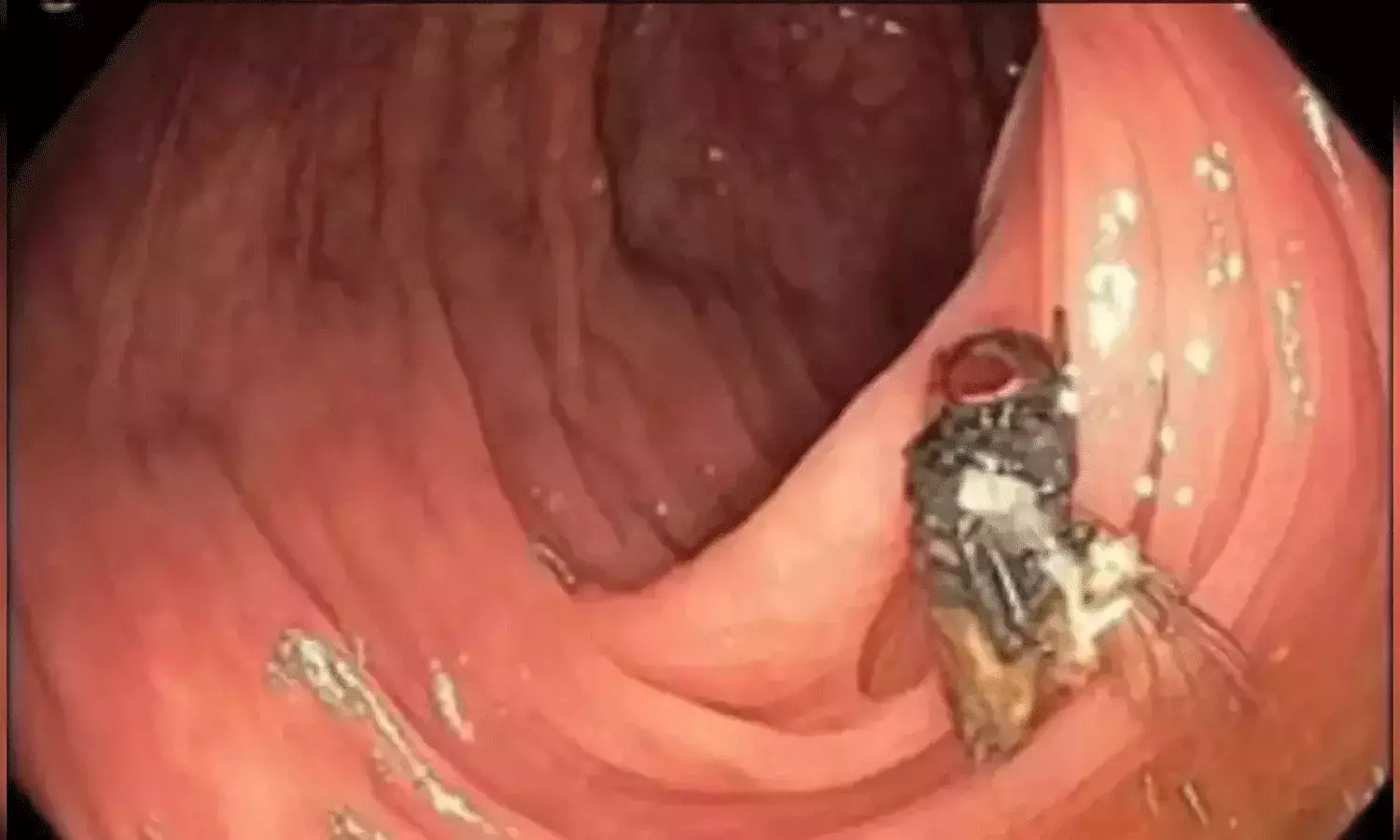 మనిషి పేగులో ఈగ.. ఖంగుతిన్న వైద్యులు