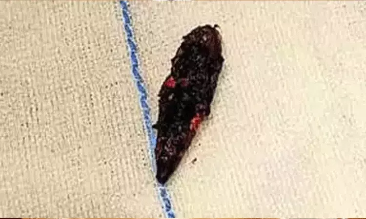 18 ఏళ్లుగా అతడి తలలో బుల్లెట్.. ఎట్టకేలకు తొలగించిన వైద్యులు 18 ఏళ్లుగా అతడి తలలో బుల్లెట్.. ఎట్టకేలకు తొలగించిన వైద్యులు