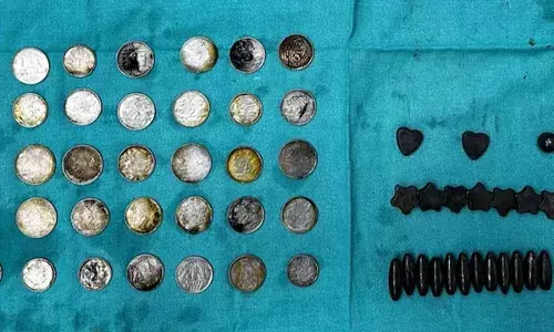 Delhi : 39 నాణేలు, 37 అయస్కాంతాలను మింగిన ఢిల్లీ వ్యక్తి Delhi : 39 నాణేలు, 37 అయస్కాంతాలను మింగిన ఢిల్లీ వ్యక్తి