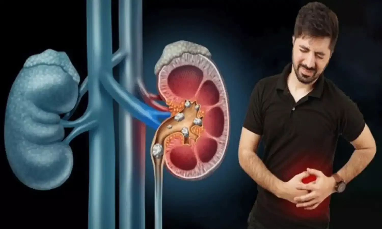 World Kidney Day : కిడ్నీలో రాళ్లు ఎలా ఏర్పడడానికి కారణాలు..జాగ్రత్తలు World Kidney Day : కిడ్నీలో రాళ్లు ఎలా ఏర్పడడానికి కారణాలు..జాగ్రత్తలు