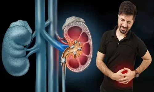 World Kidney Day : కిడ్నీలో రాళ్లు ఎలా ఏర్పడడానికి కారణాలు..జాగ్రత్తలు