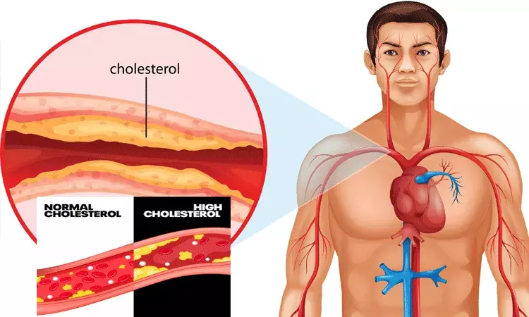 చెడు కొలెస్ట్రాల్ నివారణకు యోగాసనాలతో చెక్..