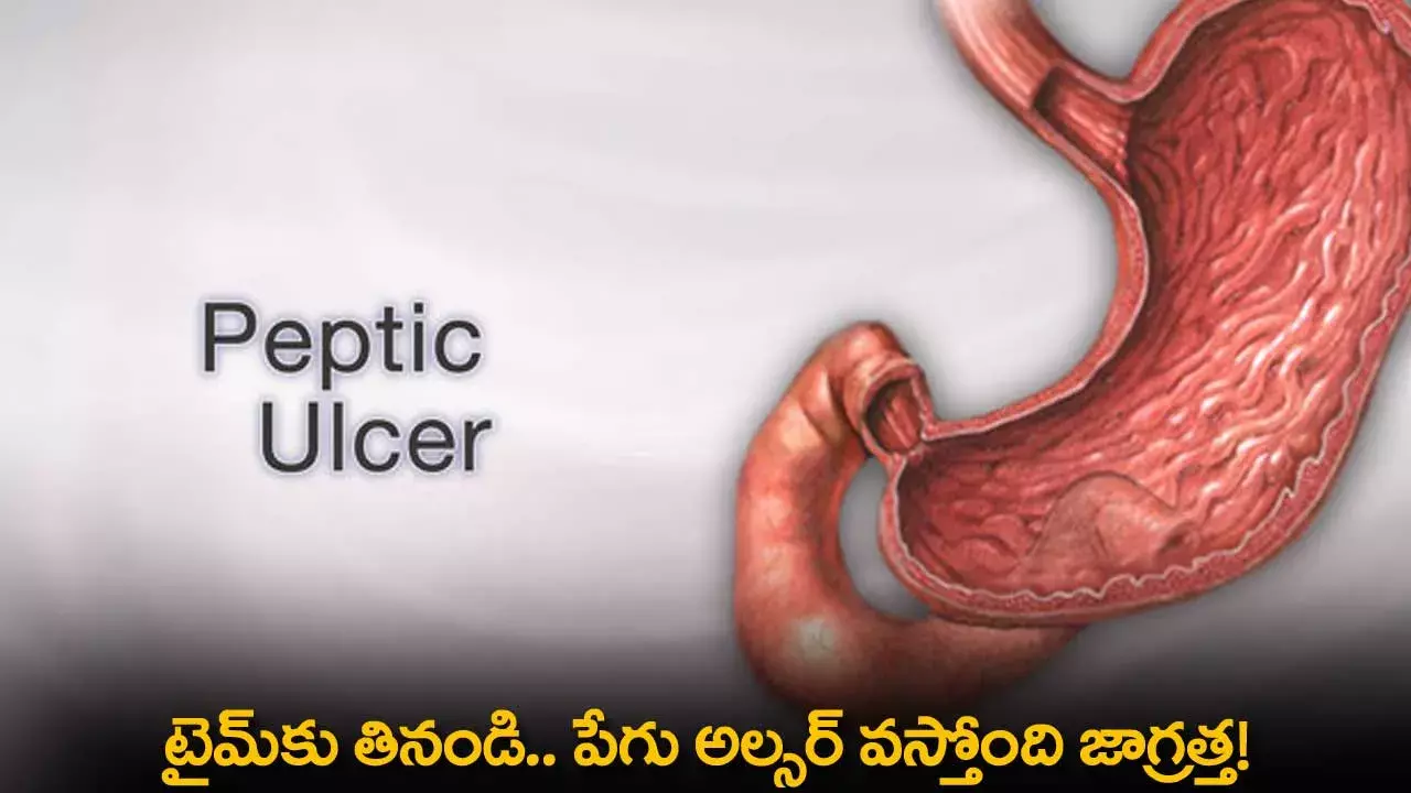 Tips : టైమ్కు తినండి.. పేగు అల్సర్ వస్తోంది జాగ్రత్త! Tips : టైమ్కు తినండి.. పేగు అల్సర్ వస్తోంది జాగ్రత్త!