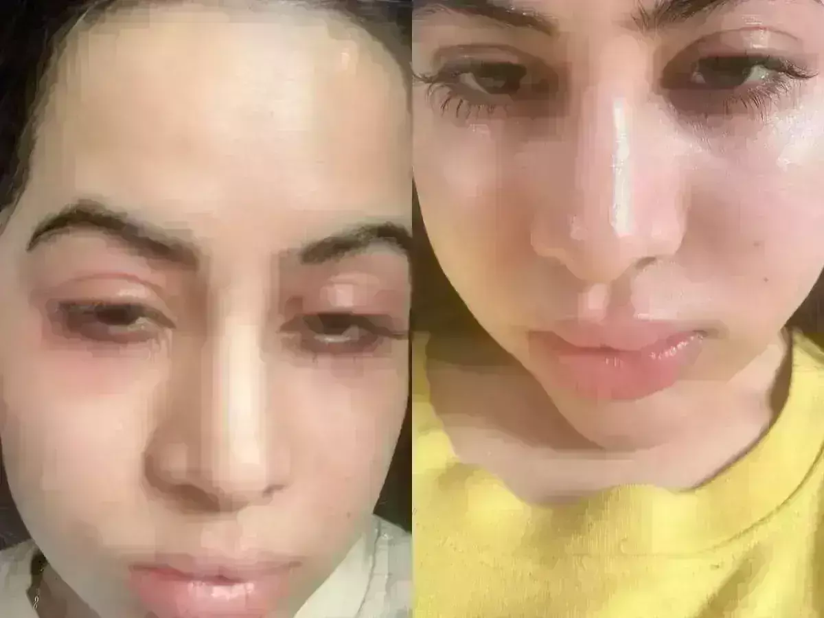 Uorfi Javed : ఆన్ లైన్ సంచలనానికి ఏమైంది.. ముఖమేంటీ ఇలా అయిపోయింది..?