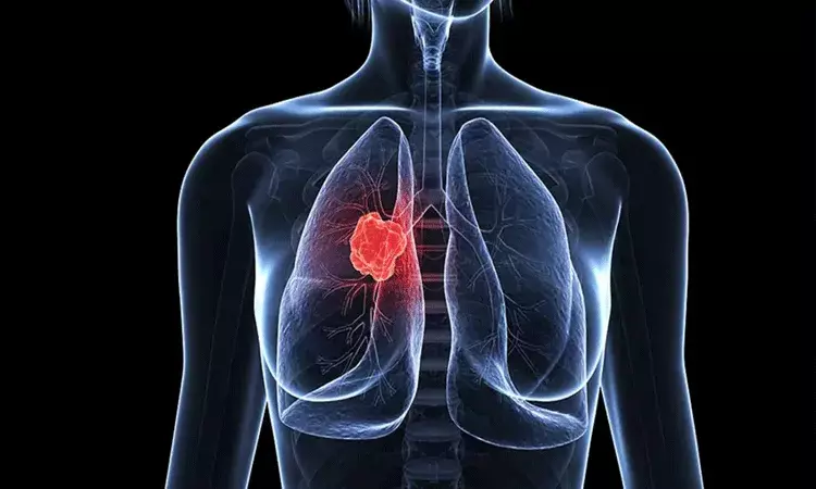 ధూమపానం చేయని వారిలోనూ ఊపిరితిత్తుల క్యాన్సర్.. వాయు కాలుష్యం ప్రధాన కారకంగా.. ధూమపానం చేయని వారిలోనూ ఊపిరితిత్తుల క్యాన్సర్.. వాయు కాలుష్యం ప్రధాన కారకంగా..