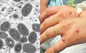 Mpox : మళ్లీ మంకీపాక్స్‌ కలకలం.. కేరళలో ఇద్దరికి పాజిటివ్