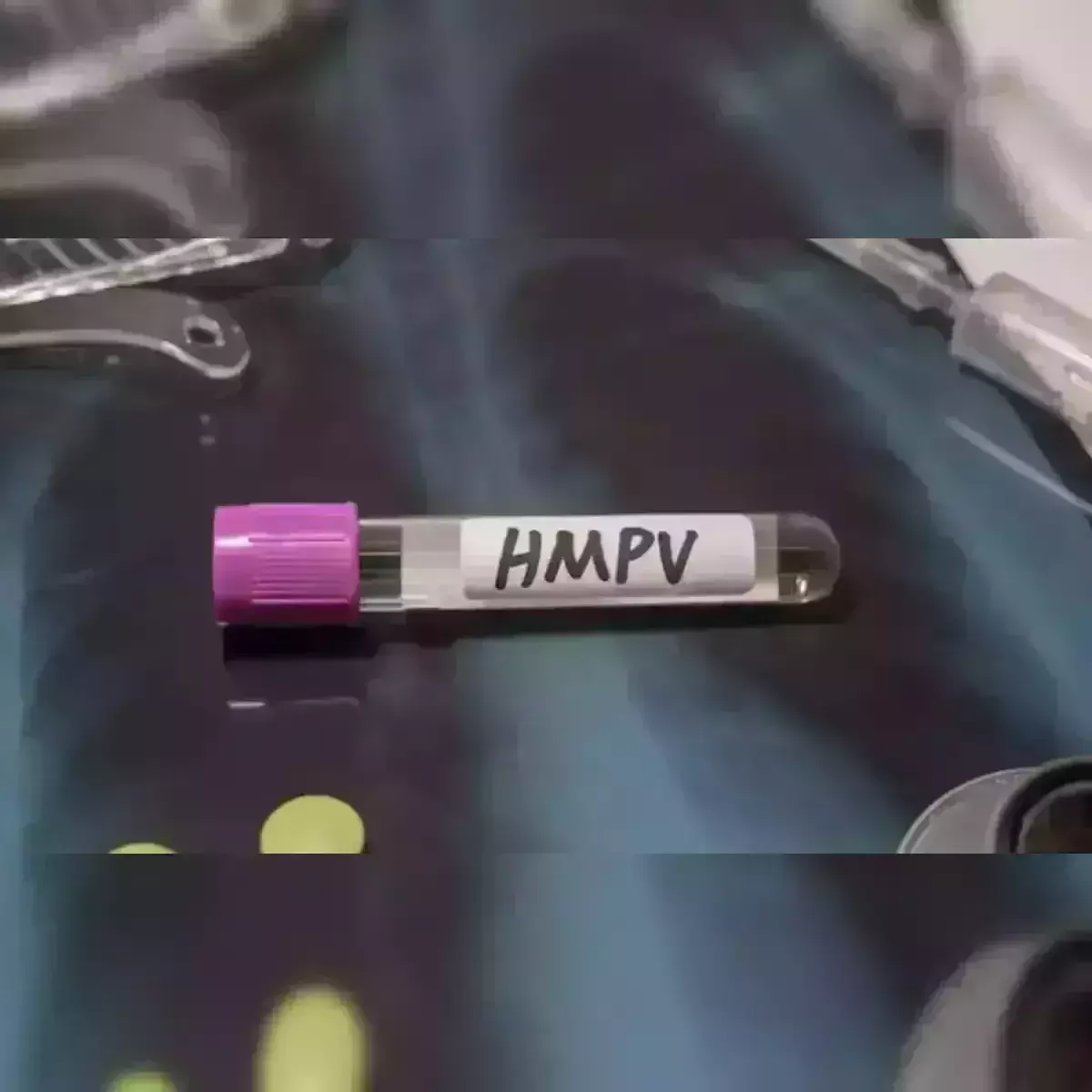 HMPV:  గుజరాత్లో మరో బాలుడికి HMPV HMPV:  గుజరాత్లో మరో బాలుడికి HMPV