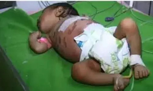 Odisha:  రోగం పోవాలని పసివాడికి 40 వాతలు Odisha:  రోగం పోవాలని పసివాడికి 40 వాతలు