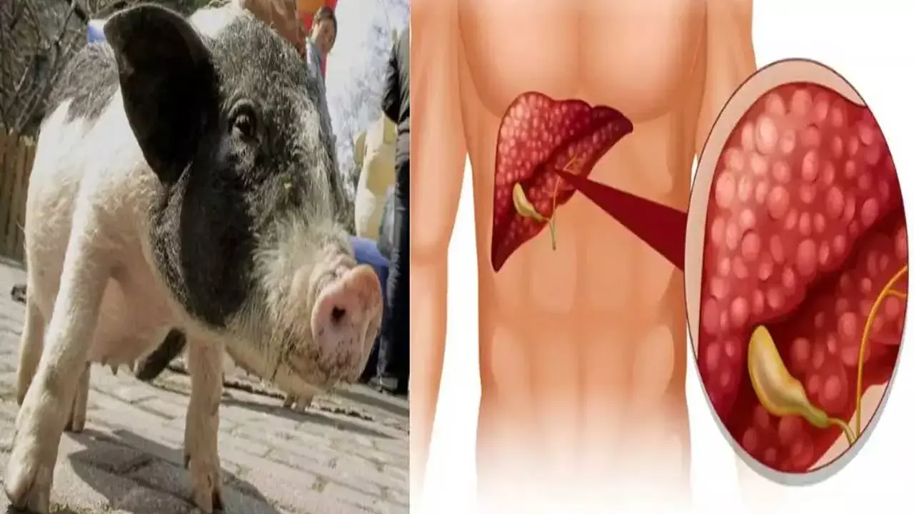 Pig Liver Transplantation : మనిషికి పంది కాలేయం