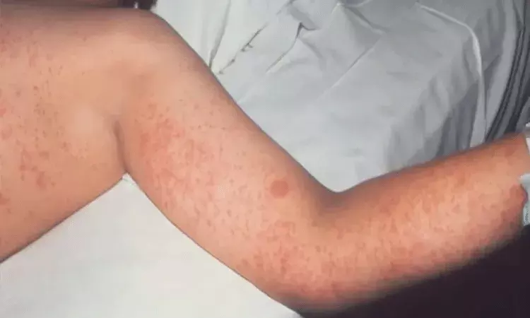 America: మీజిల్స్ తో మృతి చెందిన రెండో చిన్నారి.. దాదాపు 650 మందికి అస్వస్థత America: మీజిల్స్ తో మృతి చెందిన రెండో చిన్నారి.. దాదాపు 650 మందికి అస్వస్థత